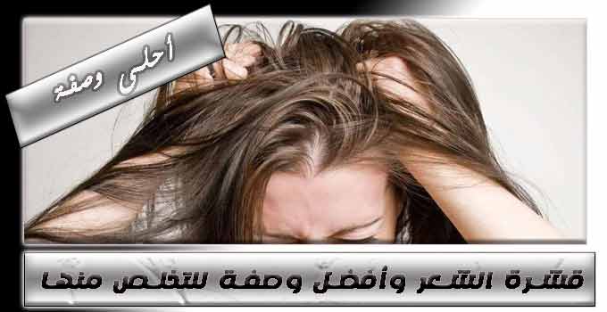 قشرة-الشعر-وأفضل-وصفة-للتخلص-منها.jpg